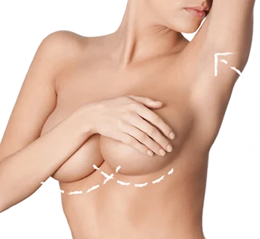 Breast Augmentation in Munich - Breastetics